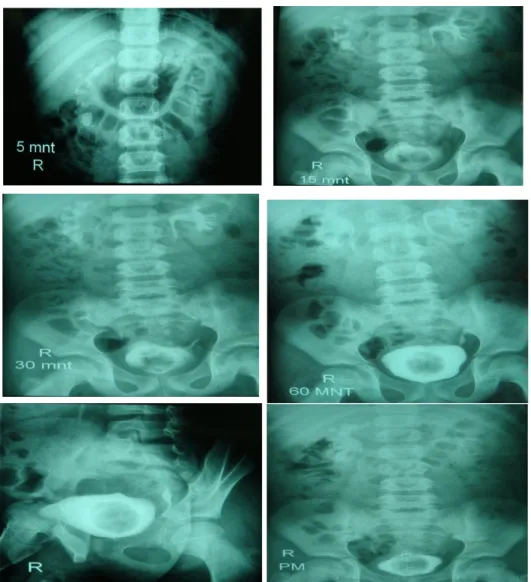 Gambar 3.4. IVP, terdapat batu radio-opak  ginjal kanan, hidronefrosis  derajat I dengan dilatasi pelvis renalis tanpa dilatasi kaliks, kaliks tampak 