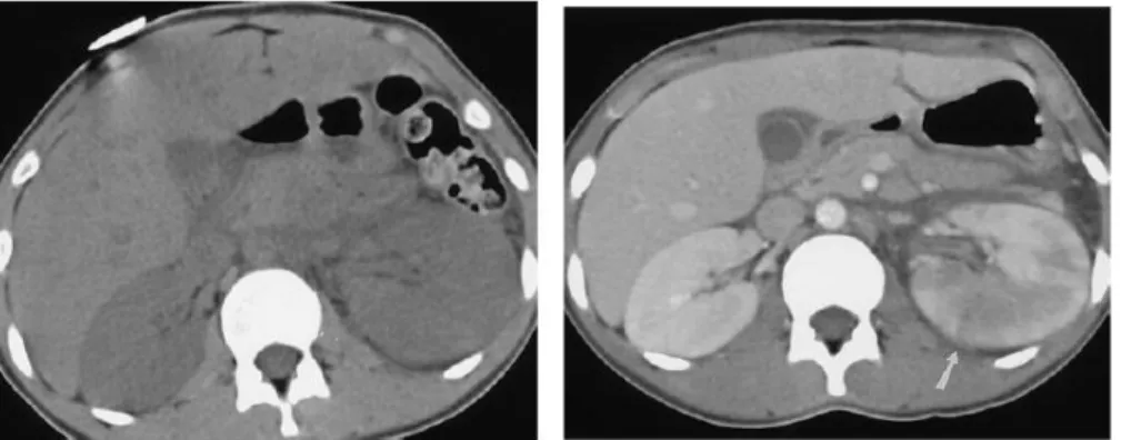 Gambar 3.9 CT-Scan pielonefritis akut, kiri=dengan kontas, kanan=tanpa kontras,   