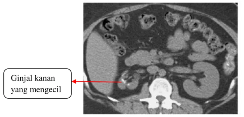 Gambar 3.10 CT-Scan dengan pielonefritis kronis 9 