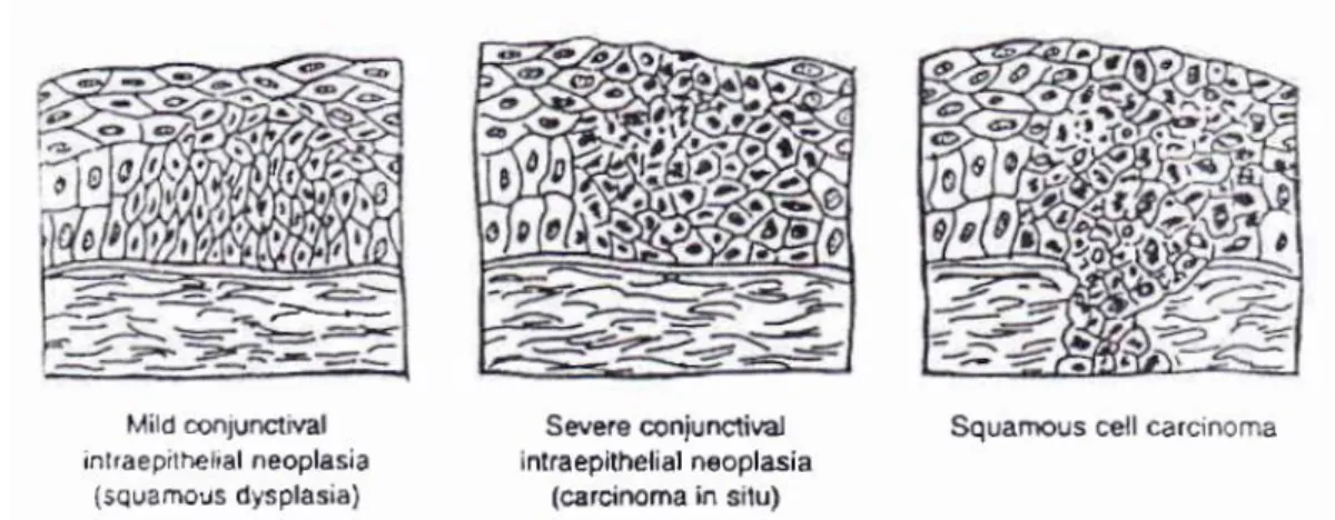 Gambar 2.2 Neoplasia epitel konjungtiva. 