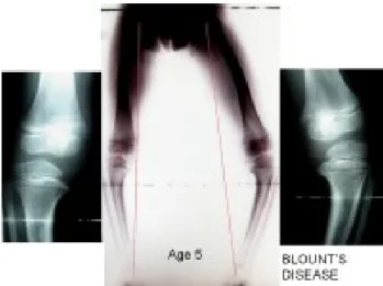 Gambar 2.5 Pada usia 5 tahun, anak ini disajikan dengan asimetris tibia vara (penyakit Blount)