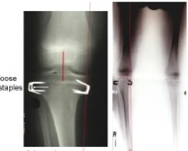 Gambar 2.8 Pada 1 tahun setelah tibia proksimal stapel untuk memperbaiki ketimpangan tungkai panjang, scanogram ini menunjukkan longgarnya staples lateral