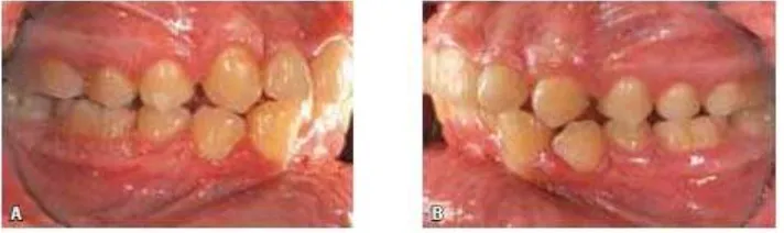 Gambar 13. Analisa tomogram airway: A, sebelum dan B, setelah perawatan