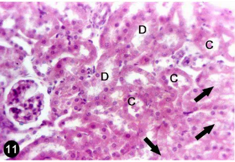 Gambar 2.10  Gambaran bagian ginjal tikus yang mendapat MSG  memperlihatkan  degenerasi hidropik  dan vakuolisasi tubulus (panah), dilatasi tubulus (D) dengan hyaline casts (C) (Abbas, et al., 2012) 
