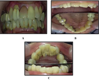 Gambar 4.1. Gambaran klinis rongga mulut subjek laki-laki berusia 37 tahun.                     A