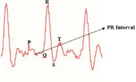Gambar 16.  Gelombang detak jantung berdasarkan P, Q, R,  S dan T rileks 