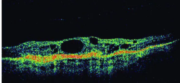 Gambar 2.1 OCT pada DME. Tampak adanya penebalan retina dan area cystoid   (Kanski, 2011) 