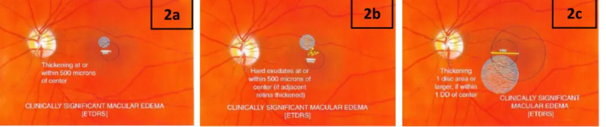 Gambar 2.2a-c. Clinically significant macular edema (CSME) (American Academy of  Ophthalmology and Staff, 2011-2012a)