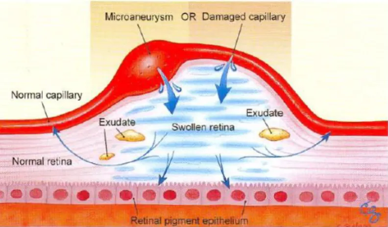 Gambar 2.4 Mekanisme DME, akibat gangguan pada permeabilitas pembuluh darah  retina (American Academy of Ophthalmology and Staff, 2011-2012a)