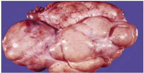 Gambar 2.16. Adult granulosa cell tumor dengan pola trabecular, sel-sel granulosa bentuk cord  dan trabekula dengan latarbelakang  stroma terdiri dari  jaringan fibrous.2 