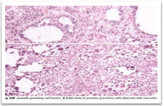 Gambar 2.19. Juvenile granulosa cell tumor tampak sarang-sarang padat sel granulosa primitif, makrofolikuler yang dibatasi populasi sel yang sama