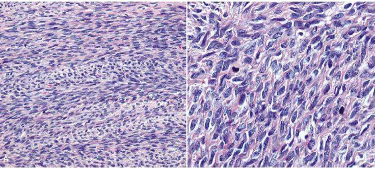 Gambar  2.20.  Fibrosarcoma dengan gambaran histopatologi inti sel atipik, sejumlah     mitotik, hearing bone patten.2