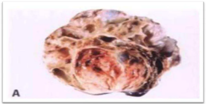 Gambar  2.21.   Penampang permukaan sertoli –leydig  cell tumor setelah dipotong tampak daerah yang padat.2 