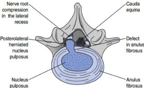 Gambar 2.4 Posterolateral herniasi diskus intervertebra  3.  Ligamen 