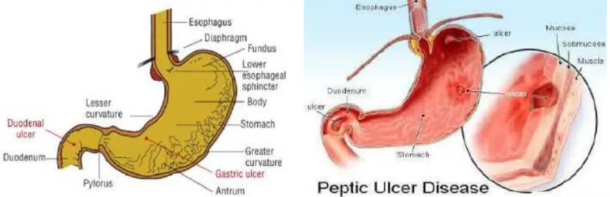 Gambar 1. Tempat Terjadinya Ulkus pada Lambung dan Duodenum (Dipiro dkk,!!"#