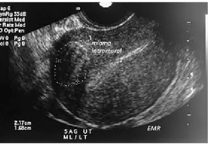 Gambar 2.4  Gambaran USG mioma intramural 4. Mioma intraligamenter 