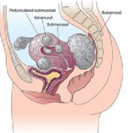 Gambar 2.1 Jenis mioma uteri