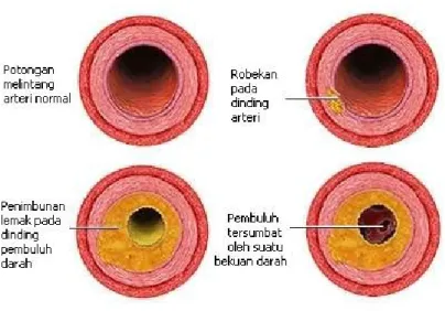 Gambar f.3 pengerasan arteri oleh plak