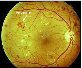 Gambar 2.10    Perdarahan pada retinopati diabetik non‐proliferatif 