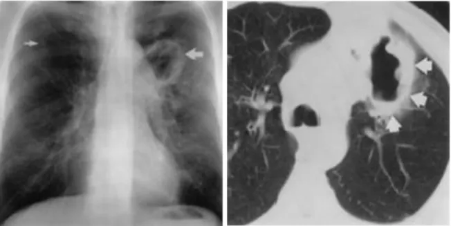 Gambar 13. Distribusi atipic postprimer TB pada seorang pria 62 tahun. (a) Foto thorax 