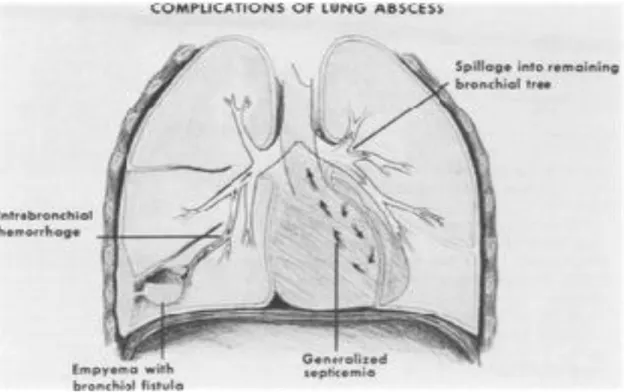 Gambar 14. Komplikasi utama dari abses paru meliputi (a) fistula bronchopleural,  menyebabkan nanah dapat masuk ke dalam cavum pleura,  