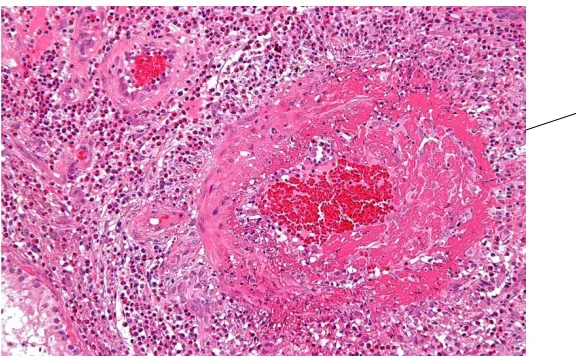 Gambar 6.Jaringan nekrosis caseosa