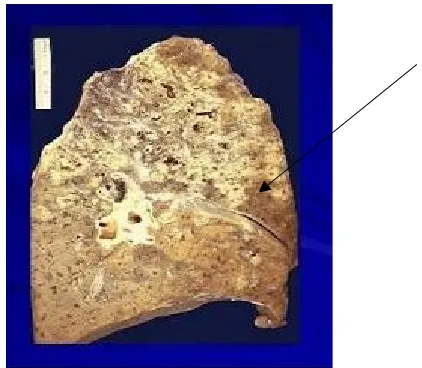 Gambar 7. Paru yang terkena nekrosis