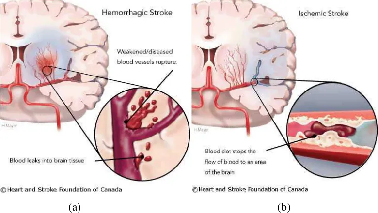 Gambar 2.2. (a) Hemorrhagic stroke. (b) Ischemic stroke. Heart and Stroke 