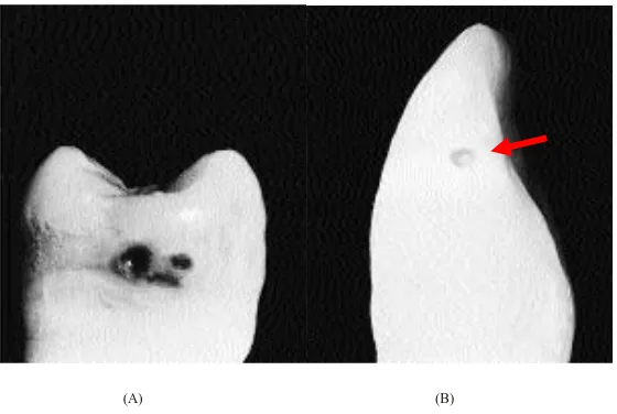 Gambar 6. Karies pada lokasi 2 ukuran 2. 17                   (A) Karies pada distal proksimal gigi premolar 1 atas