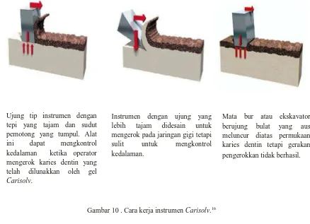 Gambar 10 . Cara kerja instrumen Carisolv.16 