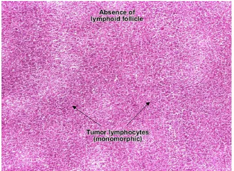 Gambar 2.1. Gambaran sitologi aspirasi biopsi Limfoma Hodgkin di atas terdiri dari populasi limfosit yang banyak aspek serta pleomorfik dan adanya sel Reed-Sternberg