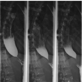 Gambar 1. Gambar menunjukan teknik dari Timed Barium  Esopphagogram (TBE) menunjukan 3 radiograf dalam satu film pada menit  ke 1,2,dan 5 setelah pemberian 250 ml Barium (dikutip dari kepustakaan 7) 