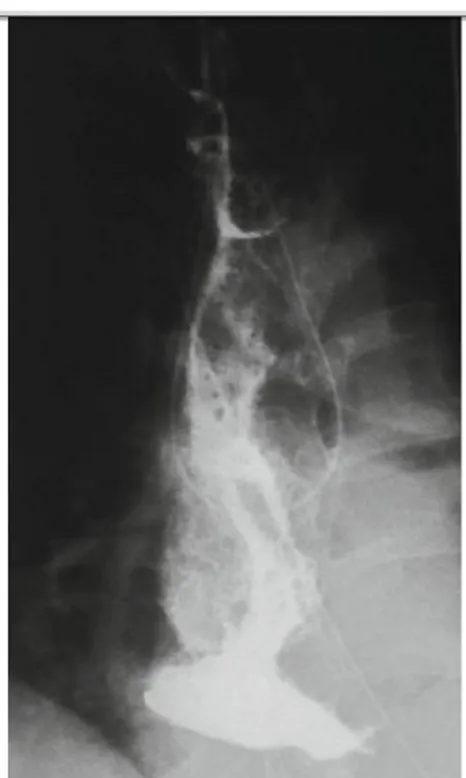 Gambar 6. Postoperative barium meal dari pasien dengan akalasia  setelah  Heller myotomy dan prosedur  anti-reflux Belsey-Mark IV (dikutip dari 