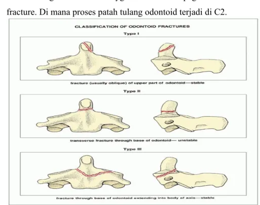 FIGURE 11.27 Classification of odontoid fractures. (Modified from Anderson LD, D'Alonzo RT