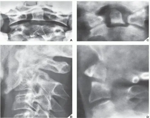 FIGURE 11.28 Fracture of the odontoid process. A 62-year-old man sustained a flexion injury of the cervicalspine in an automobile accident