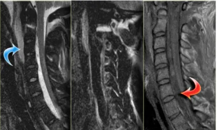 Gambar 3.12 MRI Odontoid Fracture  b) Trauma Hiperekstensi