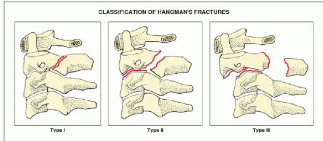 FIGURE 11.33 Classification of hangman's fractures. (Modified from Levine AM,  Edwards CC