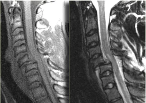 Gambar 3.3 MRI Bilateral interfacetal dislocation 2. Flexion tear drop fracture dislocation