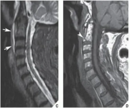Gambar 3.5 MRI Flexion tear drop fracture dislocation  proyeksi sagital