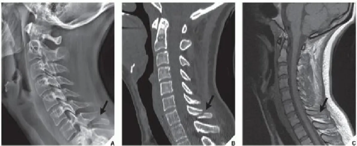FIGURE 11.43 CT and MRI of theclay shoveler's fracture. A 22year-old man injured his neck in a divingaccident