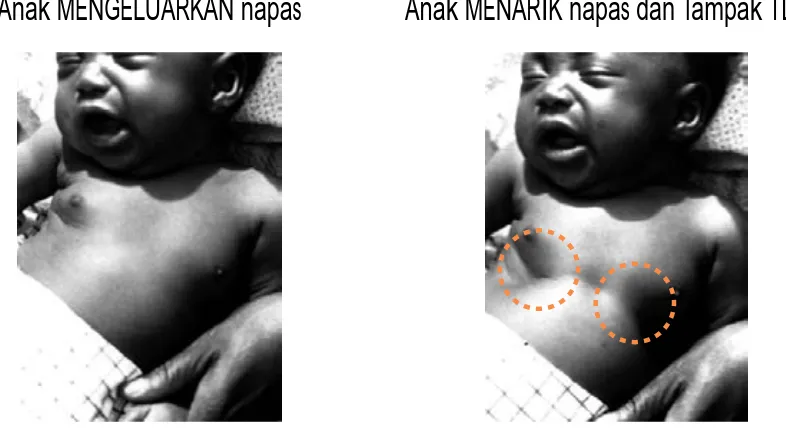 Gambar 2.1. Tarikan Dinding Dada Bagian Bawah Ke Dalam