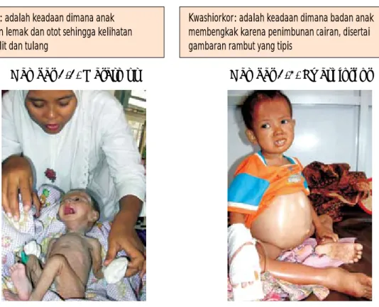 Gambar 2.2. Marasmus  Gambar 2.3. Kwashiorkor