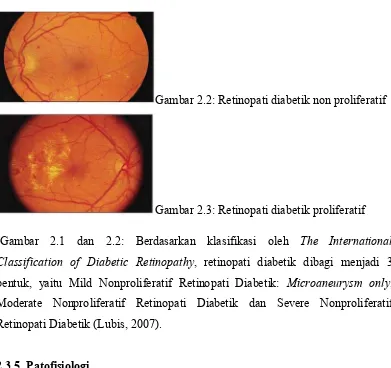 Gambar 2.2: Retinopati diabetik non proliferatif 