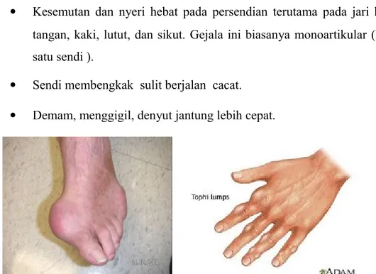 Gambar 1.8 Gejala klinis Gout Tahap – tahap penyakit asam urat : 3,4,6