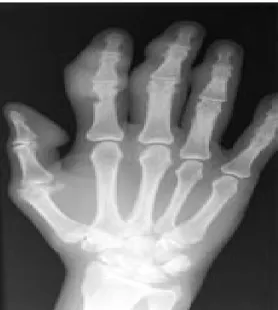 Gambar 1.10 gambaran sklerotik Gout.