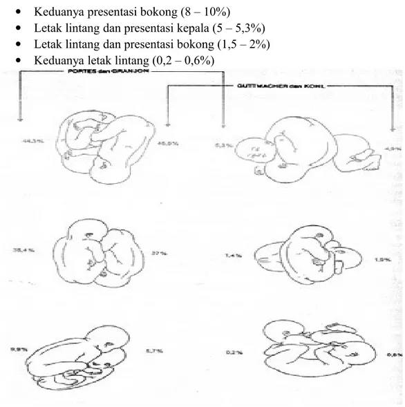 Gambar 7 : Jenis dan frekuensi letak serta presentasi kehamilan kembar (Portes &amp; 