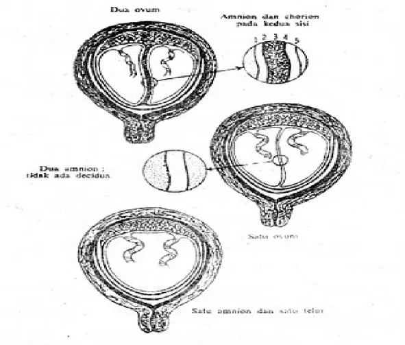 Gambar 1 : Lapisan amnion pada kehamilan ganda.