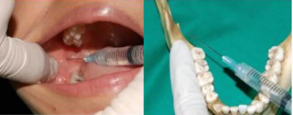 Gambar  2.  Lingual  nerve  block  sebagai  bagian  dari  mandibular  anesthesia.  Setelah  inferior  alveolar  nerve  block  selesai  dilakukan  maka  jarum  selanjutnya  ditarik  sejauh  kira-kira  10  mm,  kemudian  cairan  anestesi  diinjeksikan  perla