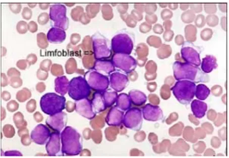 Gambar 2.8.   Leukemia Limfositik Akut  