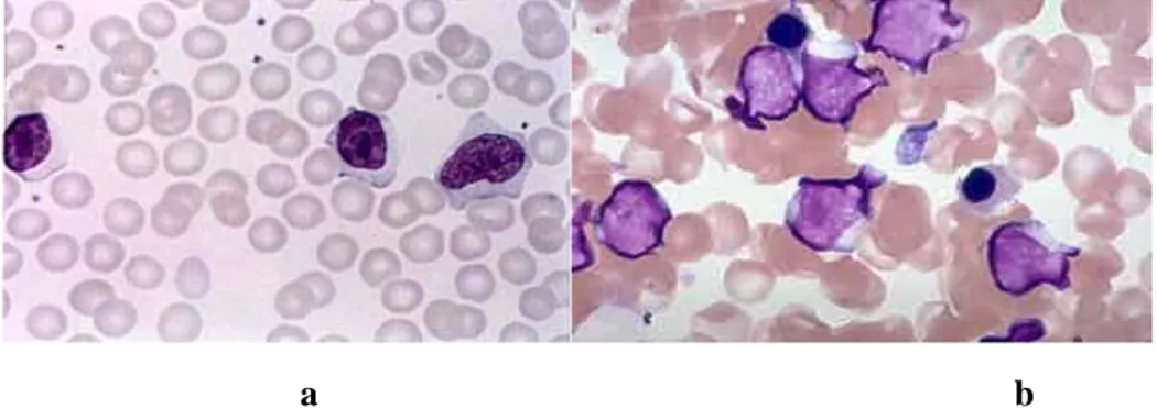 Gambar 2.10. Leukemia Limfositik Kronik 